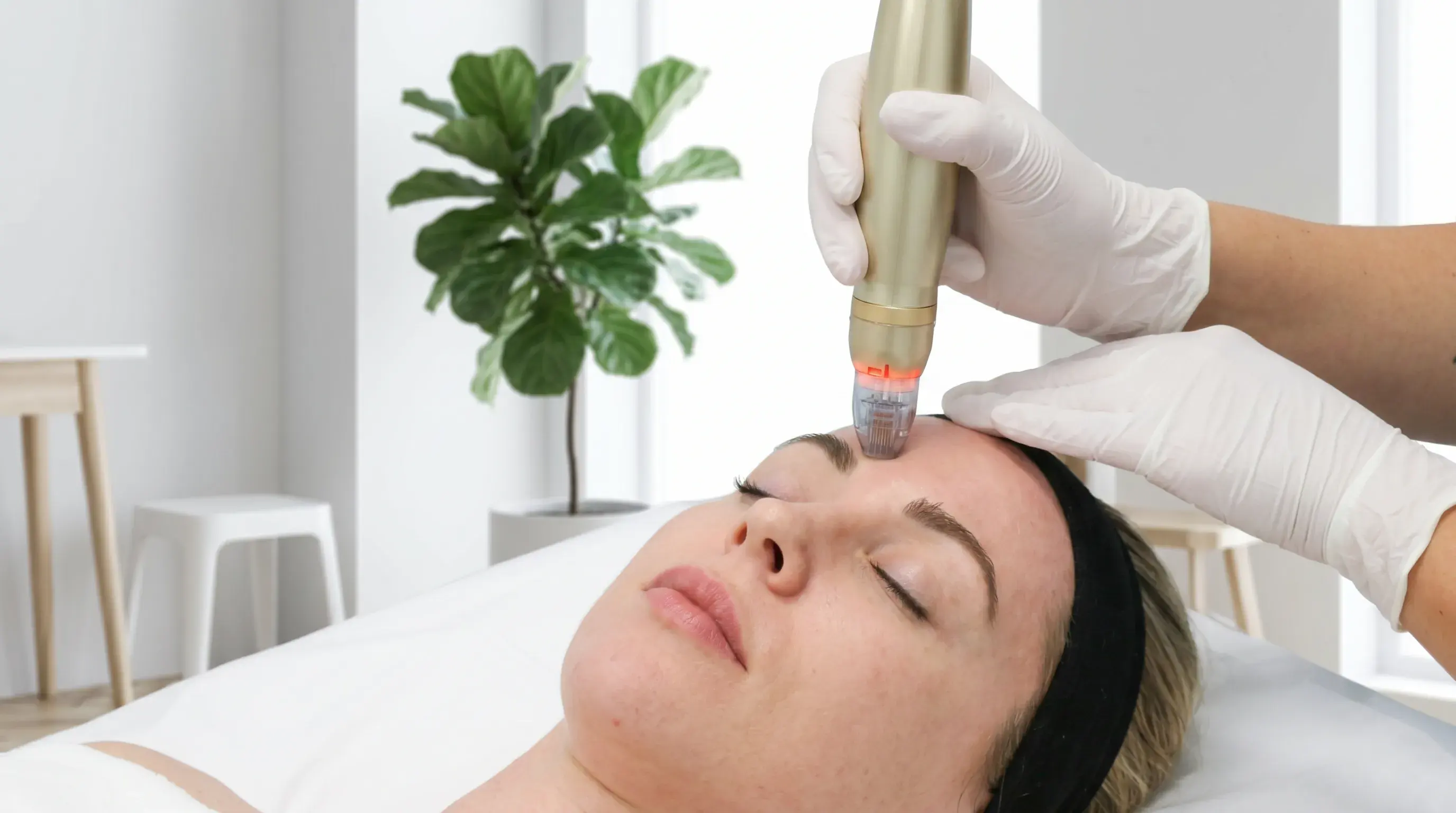 SylfirmX RF Microneedling