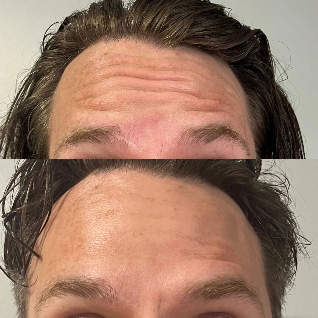 Forehead Botox before and after
