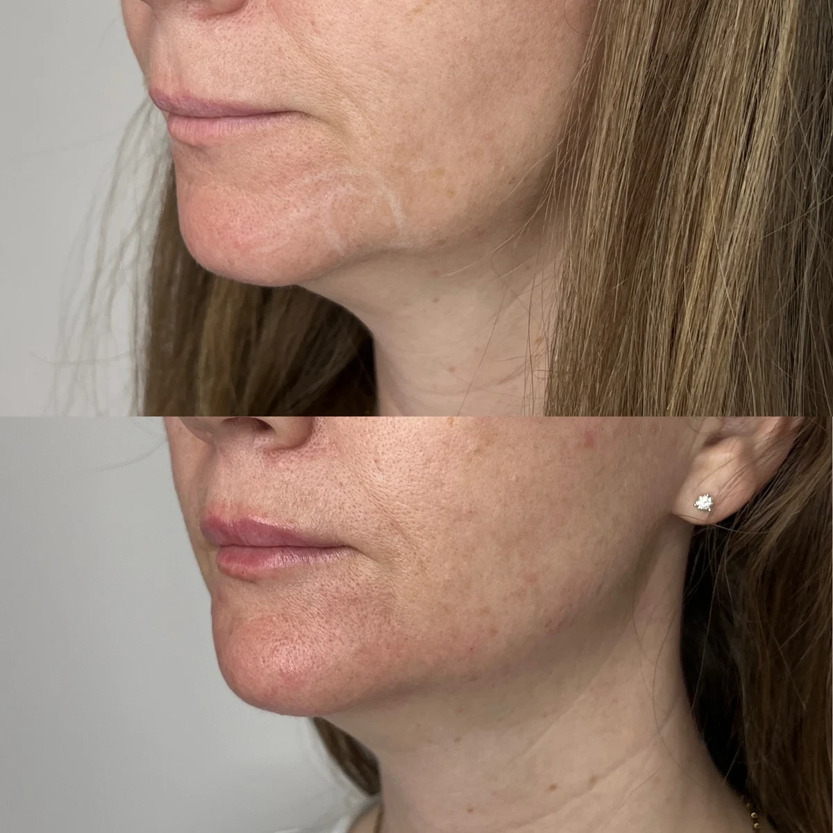 Chin Filler before and after