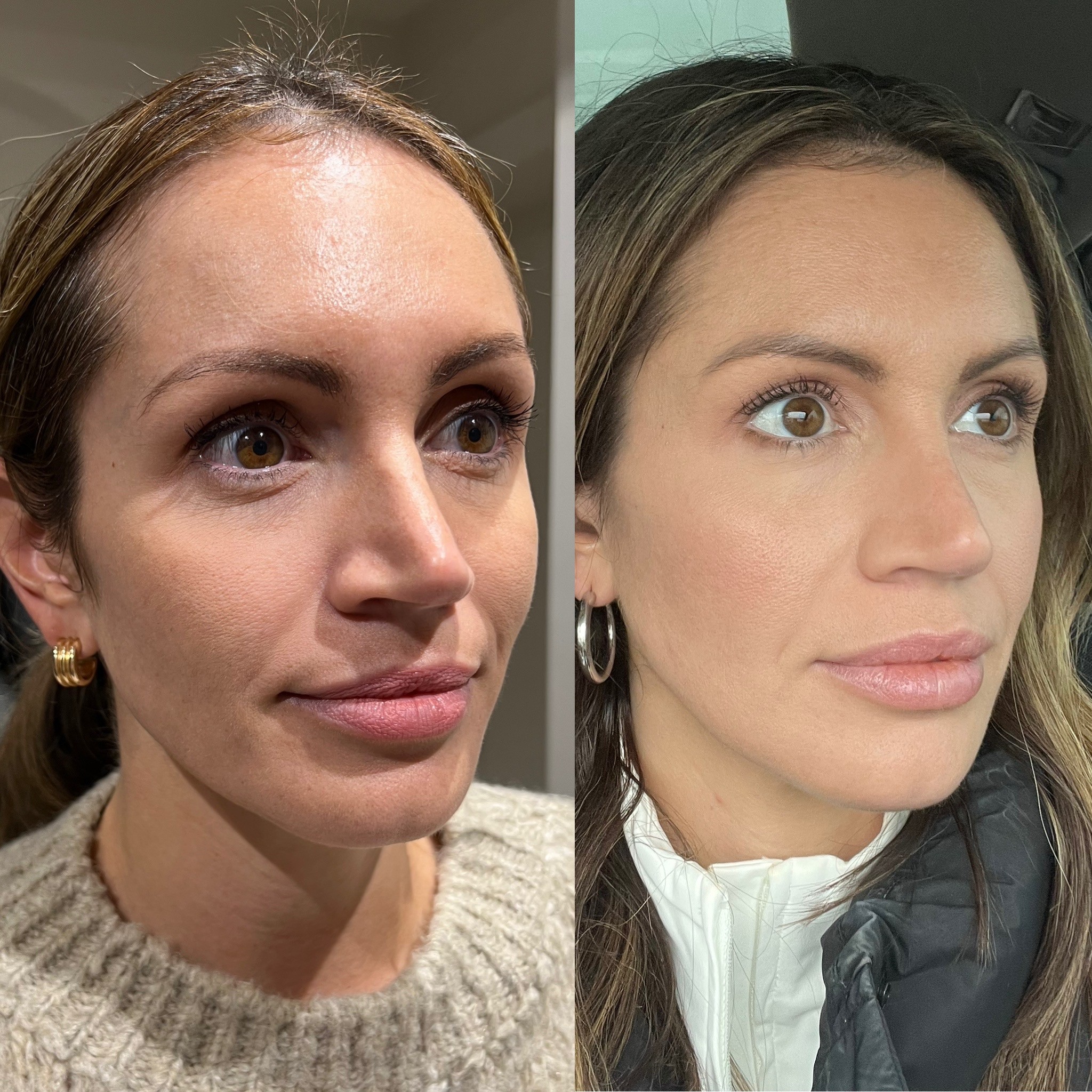 Lip filler result before and after