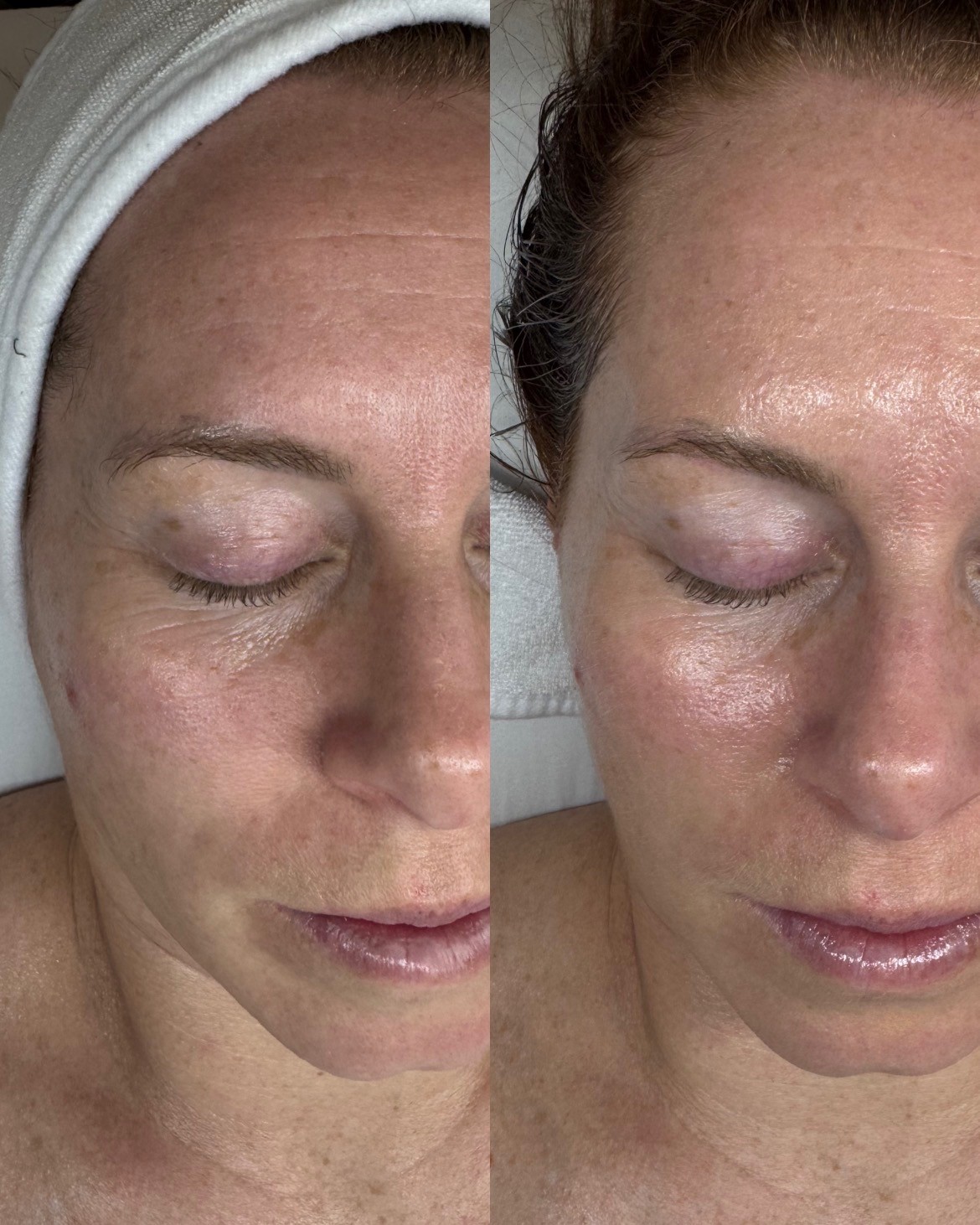 JetPeel for under-eye brightness before and after