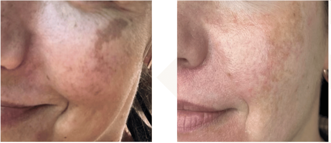 SylfirmX for melasma before and after