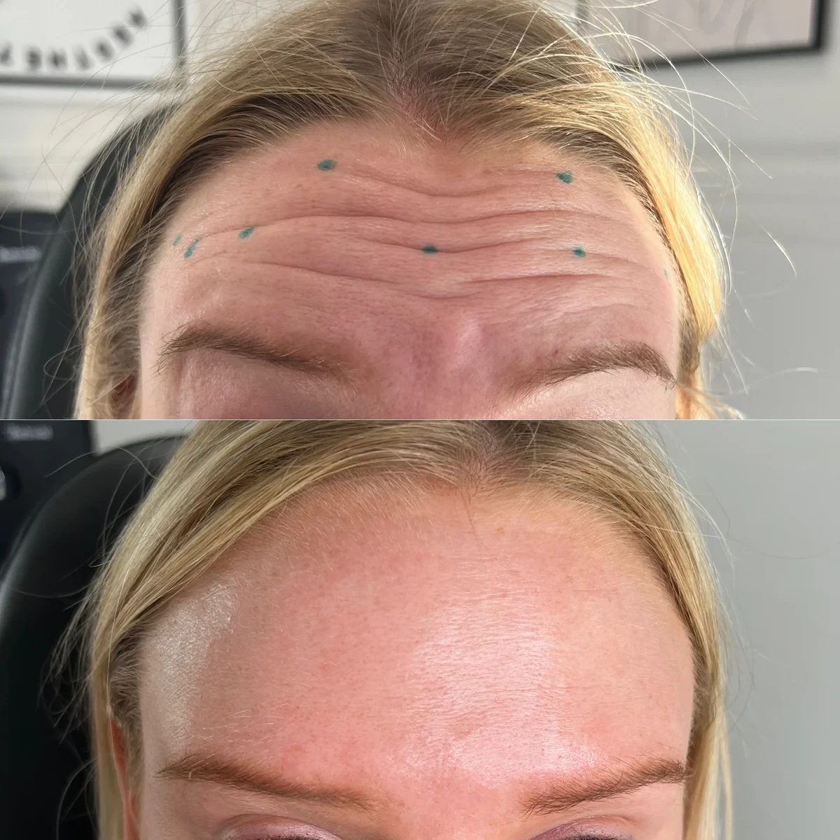 Botox forehead before and after