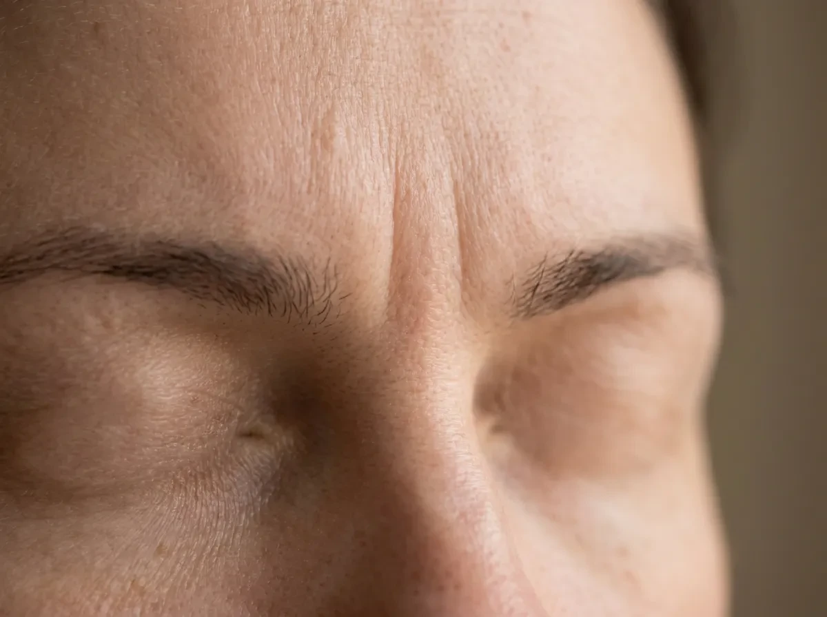 vertical 11 frown lines between the brows